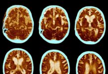 Семаглутид не зупинив прогресування хвороби Альцгеймера у великих клінічних дослідженнях