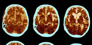 Семаглутид Не Остановил Прогрессирование Альцгеймера в Крупных Клинических Исследованиях