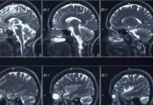 FDA Approves Trials for “Brain Pacemaker” to Treat Resistant Depression