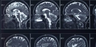 La FDA approva le sperimentazioni per il “pacemaker cerebrale” per il trattamento della depressione resistente